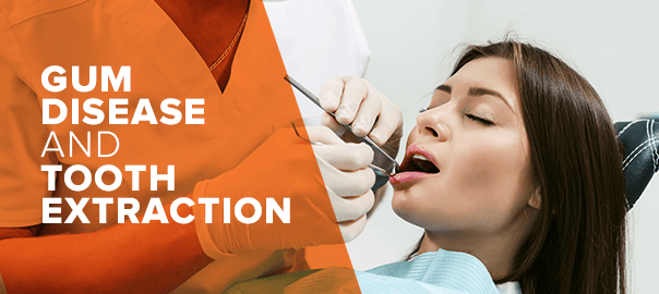 Tooth Extraction from Gum Disease